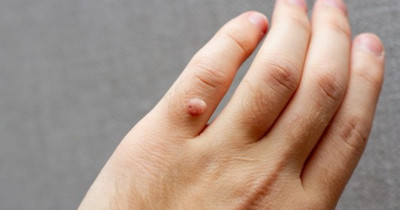5 Cara Menghilangkan Kutil di Tangan