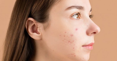 50 Skincare untuk Menghilangkan Bekas Jerawat, Rekomendasi Terbaik